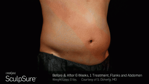 after sculpsure treatment san diego