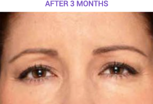 3 months after botox eros beauty and wellness