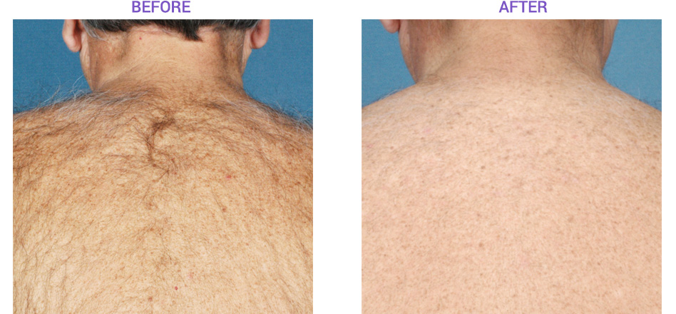 Laser Hair Removal with Elos