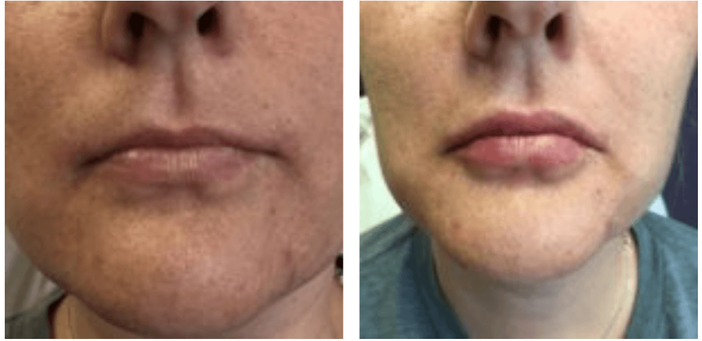 Is Lip Augmentation for You?