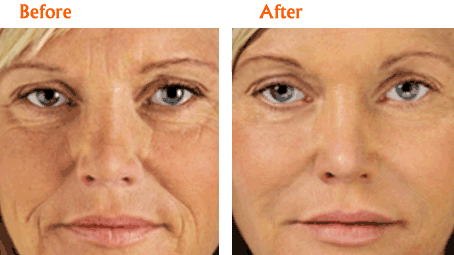 Liquid Facelift: A Non-Surgical Solution to Restore Youthful Volume