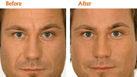 Liquid Facelift: A Non-Surgical Solution to Restore Youthful Volume