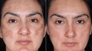 Sun Damage Control San Diego
