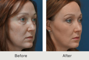 woman before and after Liquid Facelift