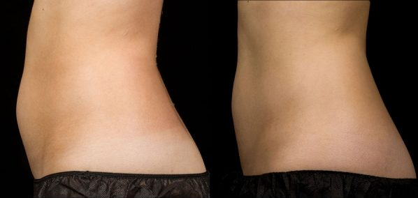 before and after abdomen black background