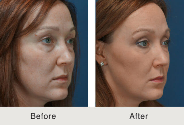 Am I a Good Candidate for a Liquid Facelift?