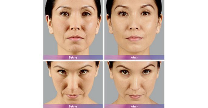 Dermal Fillers