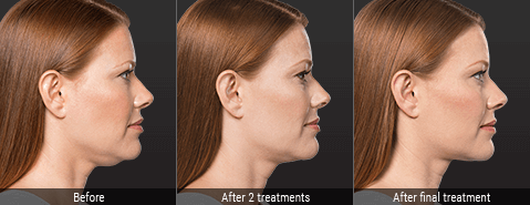 Kybella