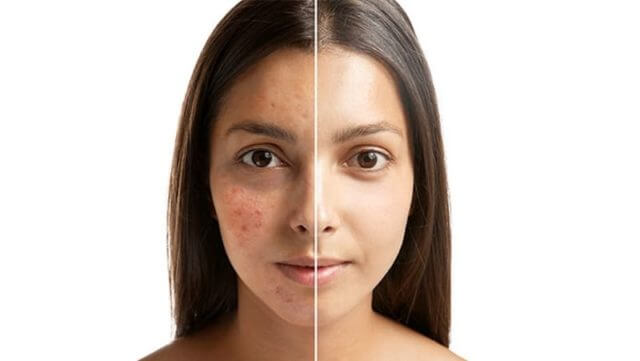 How Eros Beauty and Wellness treats acne and acne scarring