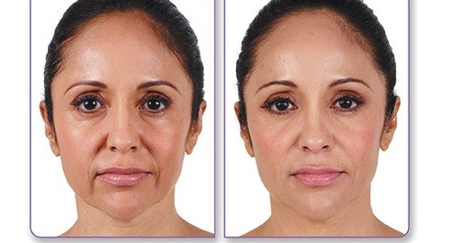 Botox® and Fillers