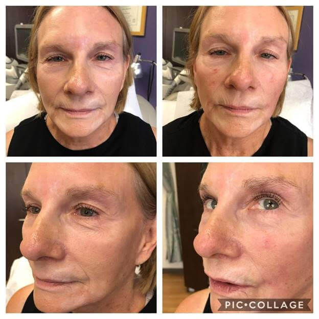 Are Fillers Right for you?