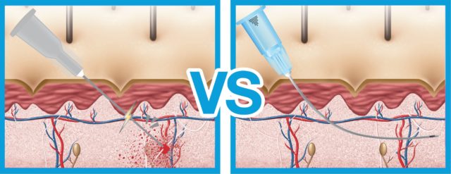Comparison chart of cannulas versus needles, illustrating their differences, benefits, and uses in cosmetic procedures.