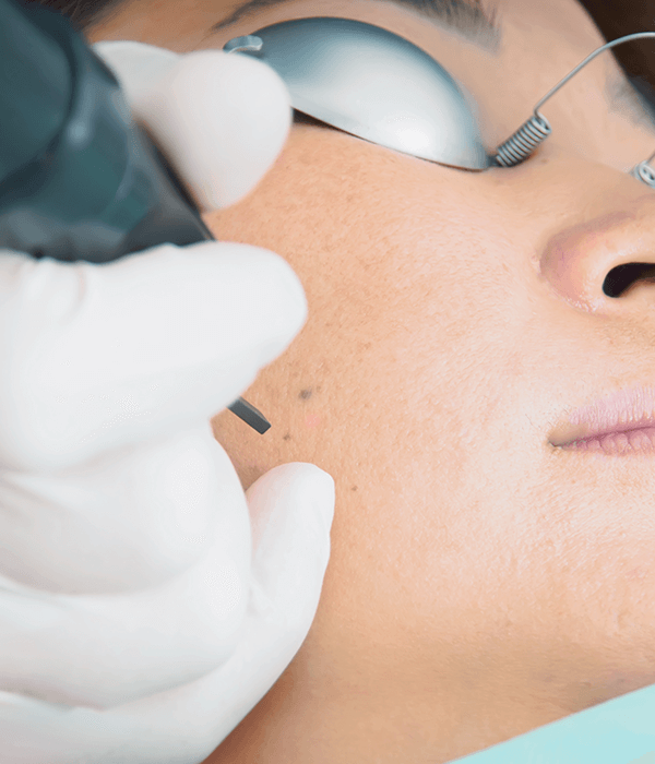 Top ND YAG Laser Mega-Sale, San Diego V2